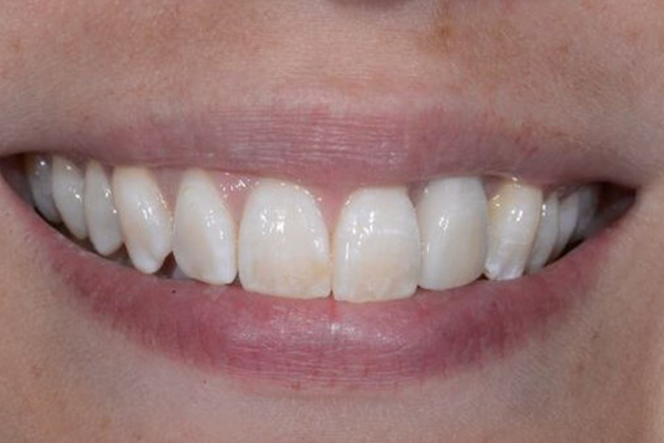 After Dental Crowns