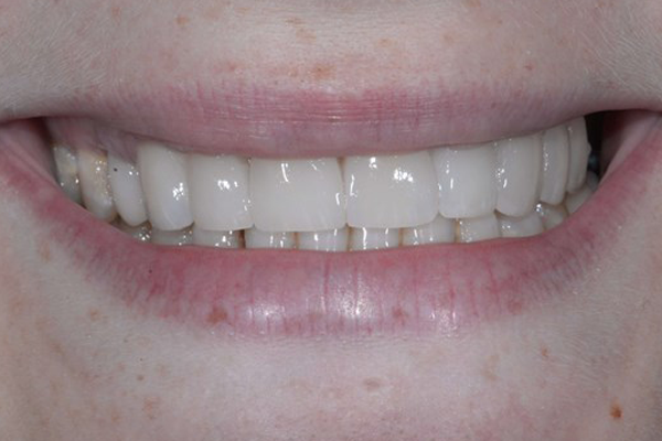 After Dental Crowns