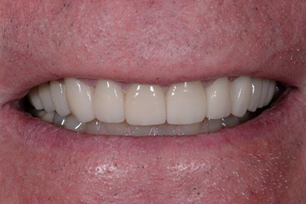 After Dental Crowns