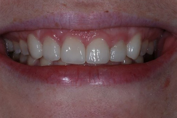 After Dental Crowns
