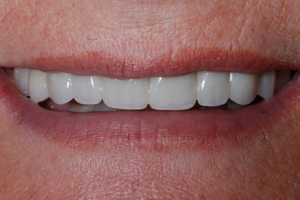 After Dental Crowns