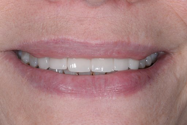 After Dental Crowns