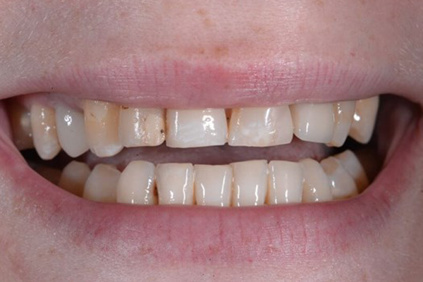 Before Dental Crowns
