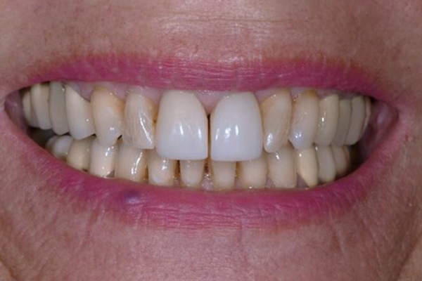 Dental Crowns