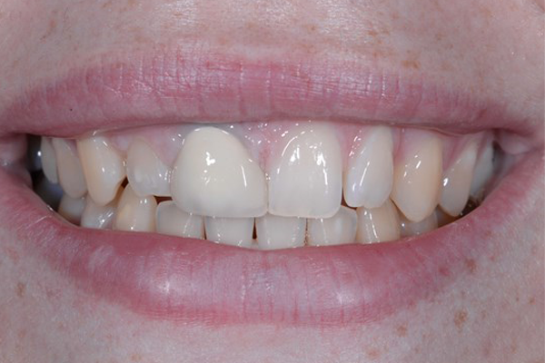 Before Dental Crowns