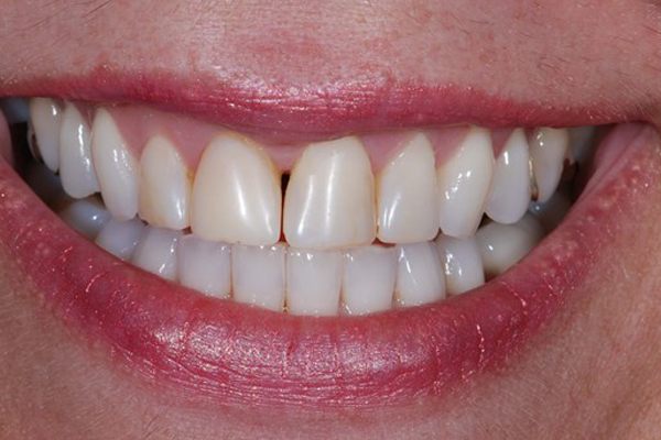 Before Dental Crowns