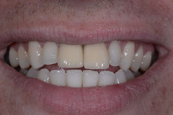 Before Dental Crowns