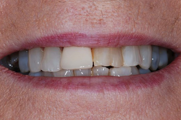 Before Dental Crowns