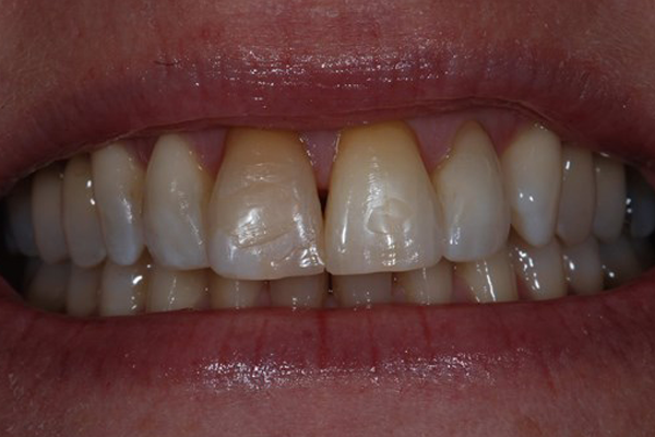 After Dental Crowns