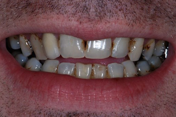 Before Dental Crowns