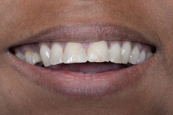Before Dental Crowns