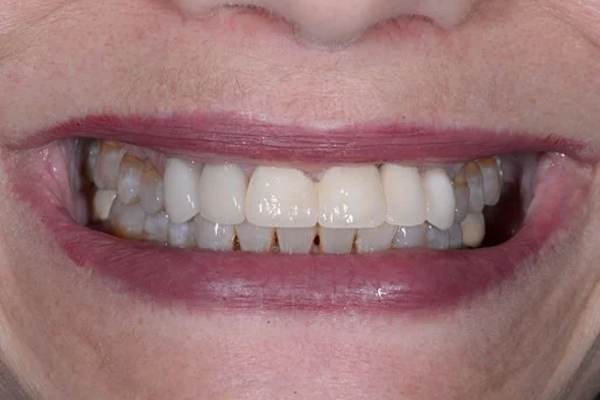 Before Dental Crowns