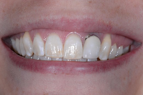 Before Dental Crowns