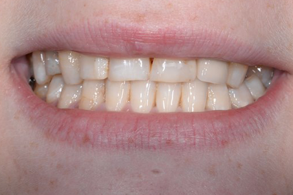 Before Dental Crowns