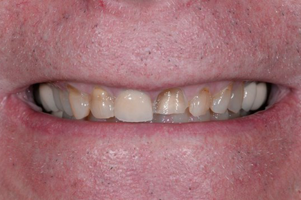 Before Dental Crowns