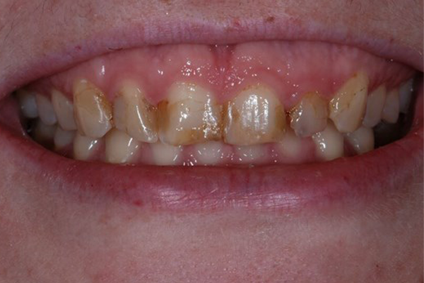 Before Dental Crowns