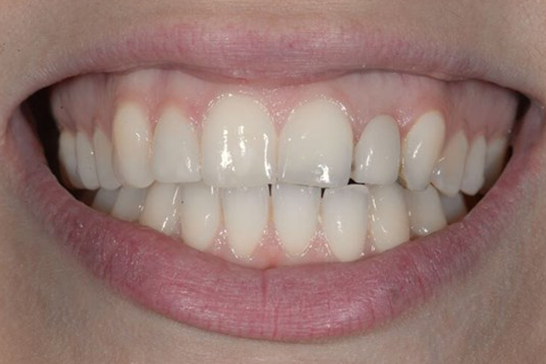Before Dental Crowns