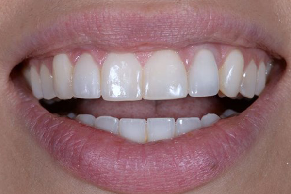 Dental Implant