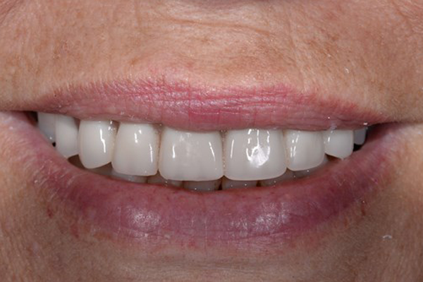 Dental Implant