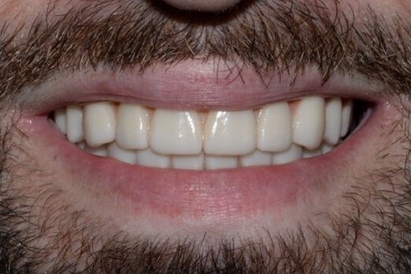 Dental Implant