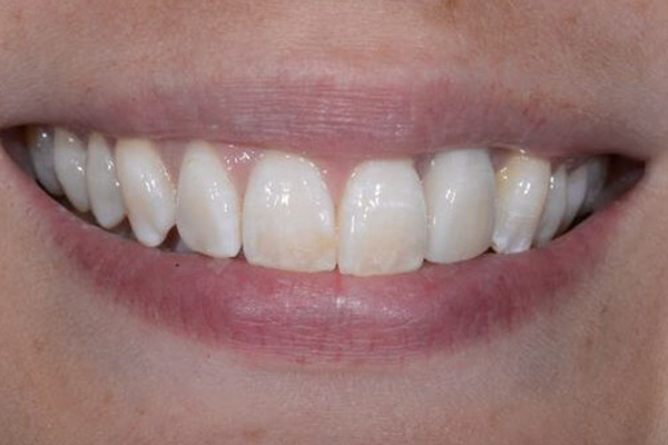 Dental Implant