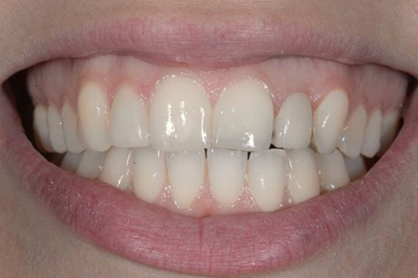 Dental Implant