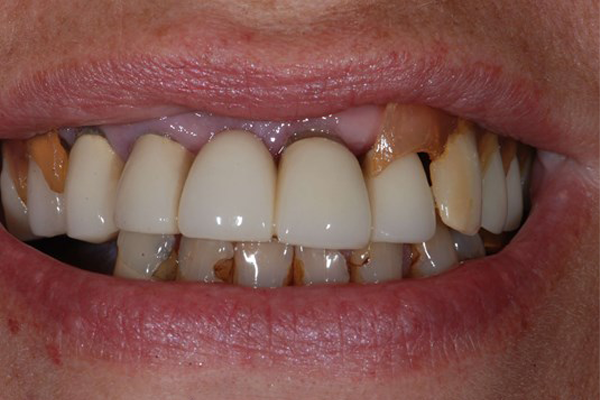 Dental Implant