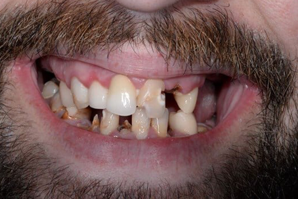 Dental Implant