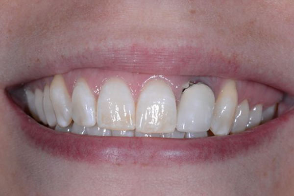 Dental Implant