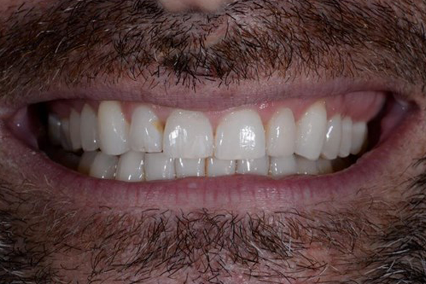 Invisalign case 2