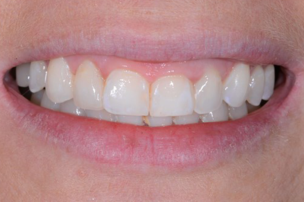 Invisalign case 4