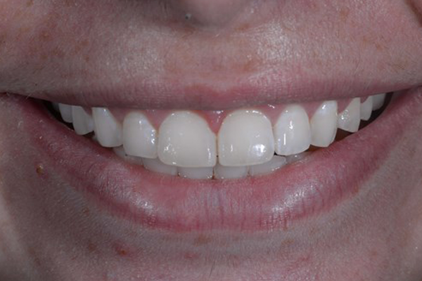 Invisalign case 6