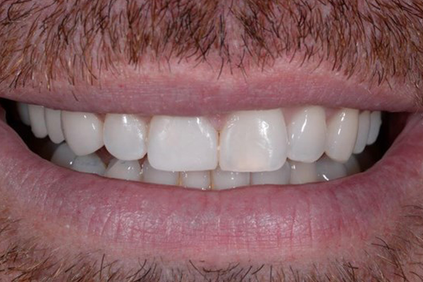 Invisalign case 8