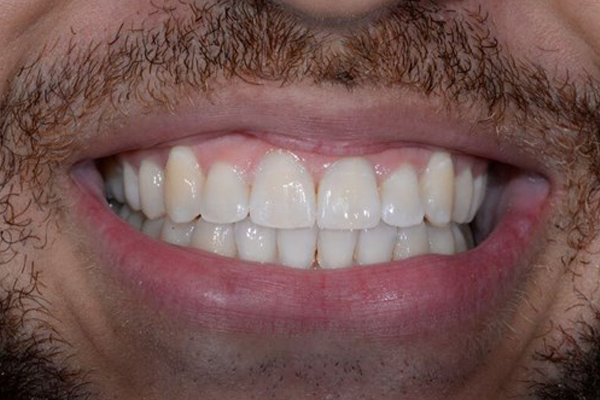 Invisalign case 10