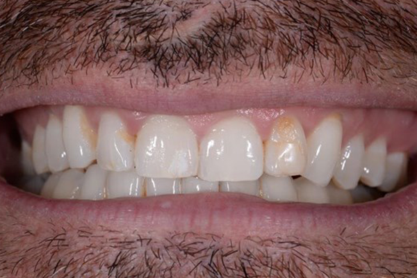 Invisalign case 1