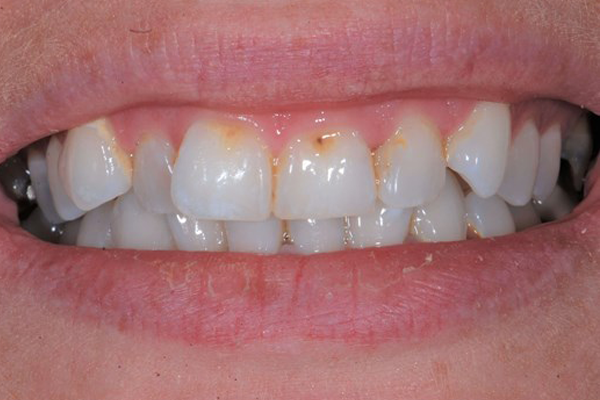 Invisalign case 3