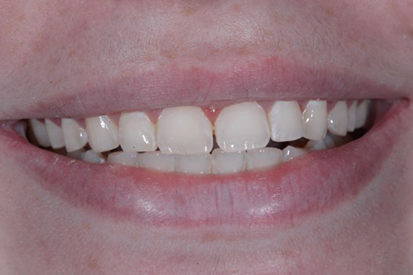 Invisalign case 5