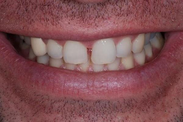 Invisalign case 7