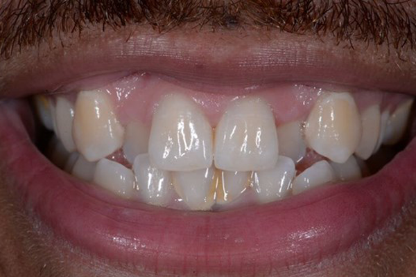 Invisalign case 9