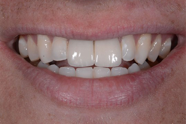 After Smile Makeover Case