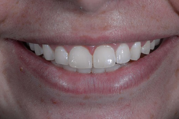 After Zoom Whitening Case