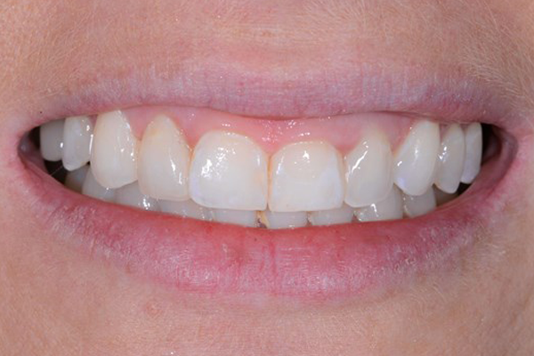 After Zoom Whitening Case