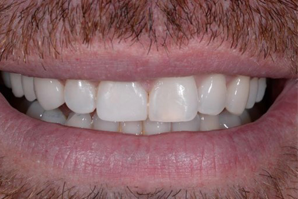 After Zoom Whitening Case