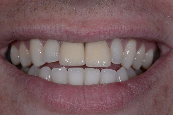 Before Smile Makeover Case
