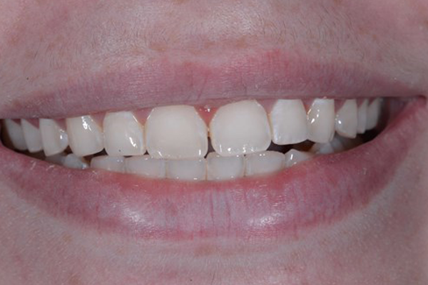 Before Zoom Whitening Case