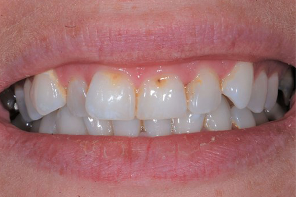 Before Zoom Whitening Case