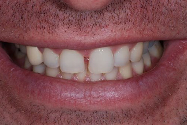 Before Zoom Whitening Case