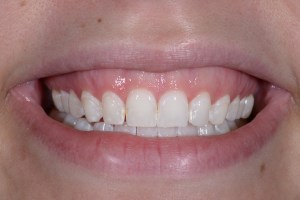 After Zoom Whitening Case