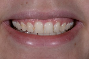Before Zoom Whitening Case