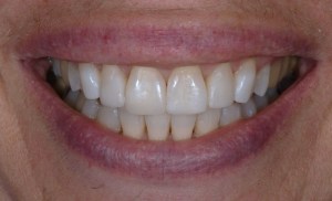 After Case E - Cosmetic Bonding - Dr. Daniel Aldieri